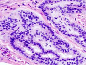 Imagen histopatológica de carcinoide de colon teñido con hematoxilina y eosina. /  KGH (WIKIMEDIA)