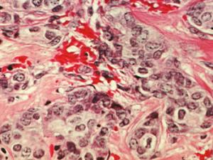 Células de cáncer de mama. / Dr. Cecil Fox (Photographer), National Cancer Institute, National Institutes of Health (FLICKR)