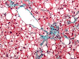 Fotografía microscópica mostrando un Hígado graso (esteatosis macrovesicular), como se ve en una esteatohepatitis no alcohólica. / Nephron (WIKIMEDIA)