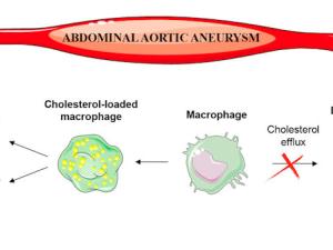 Las lipoproteínas que transportan el colesterol 'bueno' pierden su capacidad cardioprotectora en pacientes con aneurisma aórtico abdominal. / CIBER
