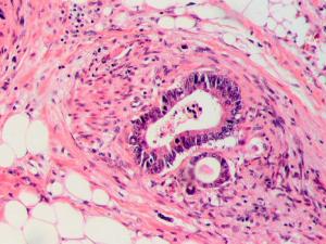 Cáncer colorrectal. / Patho (PIXABAY)