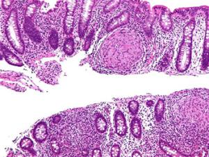 Micrografía de ampliación intermedia de la enfermedad de Crohn. Biopsia del colon. Mancha de H & E. / Nephron (WIKIMEDIA)