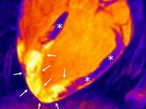 Imagen de resonancia magnética tridimensional en un sujeto tras un infarto agudo de miocardio. En el centro de la imagen aparece el corazón. / CIBERCV