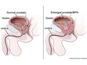 Próstata normal e inflamada. / National Cancer Institute (WIKIMEDIA COMMONS)