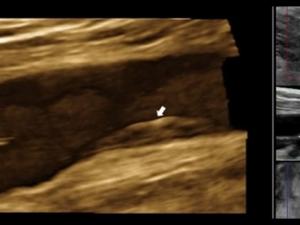 3D de la arteria femoral derecha. / CNIC