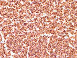 Tumor LLA procedente de un ratón donde se ha inactivado Capicúa (tinción con anticuerpos contra CD3 destacando las células T aberrantes). / CNIO