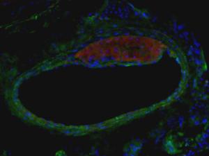 Detección de inmunofluorescencia de una placa de aterosclerosis en arteria carótida (verde: células musculares lisas; rojo: macrófagos o células espumosas; azul: núcleos) / MARIO DELGADO