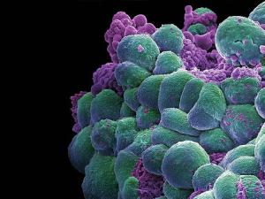 Micrografía electrónica de grupo de células de cáncer de mama. / Annie Cavanagh. Wellcome Images (FLICKR)