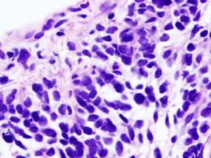 Imagen histopatológica del carcinoma de células pequeñas del pulmón. Biopsia con aguja gruesa guiada por TC. Tinción de H & E. / KGH (PIXABAY)