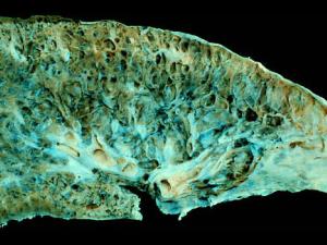 Pulmón con fibrosis pulmonar en etapa terminal en la autopsia. / (WIKIMEDIA)