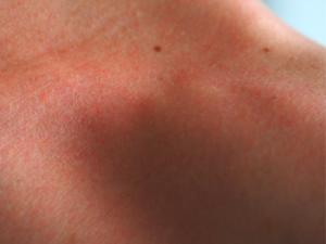 los cortes y quemaduras producidos durante el día cicatrizan hasta un 60% más rápidos que aquellos sufridos entre las ocho de la tarde y las ocho de la mañana. / Hans (PIXABAY)