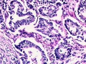 Adenocarcinoma, subtipo acinar. / 	Yale Rosen (WIKIMEDIA)