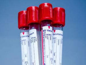 Implementa un nuevo sistema de detección rápida de la hepatitis C