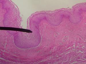 Mucosa vaginal normal, estratificada sin el desarreglo típico del cáncer de vagina. / Jpogi en Wikipedia Inglesa (WIKIMEDIA)