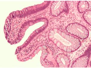 Adenoma tubular. / Nephron (WIKIPEDIA)