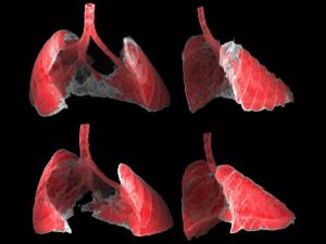 La figura muestra dos vistas, frontal y lateral, de la imagen obtenida por TAC de los pulmones de un ratón con fibrosis (zonas grises) antes y después de ser tratado con nanoterapia dirigida a las células senescentes. / G Garaulet i F Mulero, CNIO