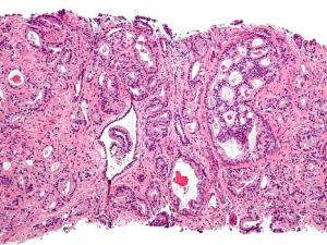 Cáncer de próstata. / Nephron (WIKIMEDIA)