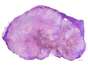 Ganglio linfático con metástasis. / Gabriel Caponetti (WIKIPEDIA)