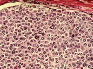 Células cáncer de mama. / Dr. Cecil Fox (WIKIMEDIA)