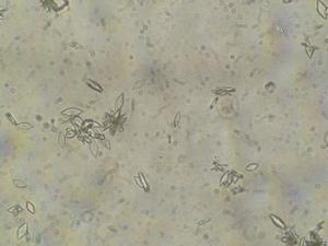 Cristales de ácido úrico en la orina. / Wikitorre92 (WIKIMEDIA)