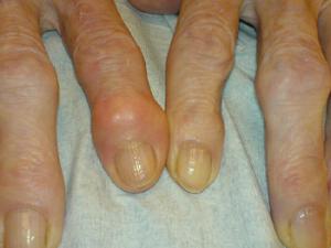 Alrededor de la mitad de las personas comenzarán a sufrir artrosis en algún momento de sus vidas. / Drahreg01 (WIKIMEDIA)