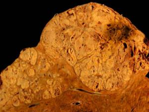 Carcinoma hepatocelular en un individuo que dio positivo por hepatitis C. Muestra de autopsia.. / (WIKIMEDIA)