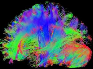 Una nueva herramienta no invasiva ayudará al diagnóstico de alzhéimer en sus fases más tempranas