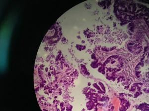 Metástasis de tumor intestinal primario a nivel del cerebro: las vellosidades intestinales clásicas, generalmente presentes en la mucosa intestinal, se observan fácilmente. / Dedebio2015 (PIXABAY)