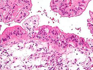 Tumor mucinoso de ovario visto bajo el microscopio, tinición HE. / Nephron (WIKIMEDIA)