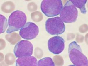  Frotis de aspirado de médula ósea teñida de Wright con paciente con leucemia linfoblástica aguda de células B precursora. / VashiDonsk (WIKIMEDIA)