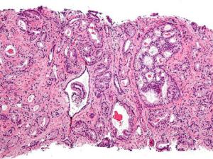 Micrografía que muestra adenocarcinoma acinar prostático (la forma más común de cáncer de próstata) patrón de Gleason 4. Tinción de H & E. / Nephron (WIKIMEDIA)