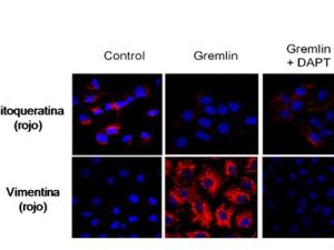 Células marcadas con fluorescencia. Azul: núcleos. Rojo: Vimentina Control: Células sanas. Gremlin: células tratadas con Gremlin en el medio de cultivo. Gremlin + DAPT: Células con Gremlin y el fármaco experimental que limita su actividad (DAPT). / UAM