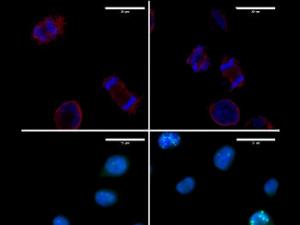 Células del melanoma donde se muestran alteraciones de la división celular (imágenes superiores) y un incremento de daño en el ADN (imágenes inferiores) cuando se elimina LOXL3. / UAM