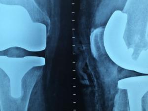 Consiguen mejorar la respuesta del cuerpo humano a los implantes. / (PIXABAY)