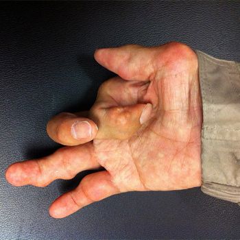 Artritis en la mano. / handarmdoc (FLICKR)